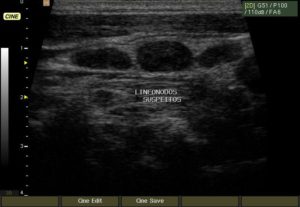 US_cervical