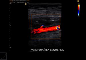 US_doppler_arterial_venoso
