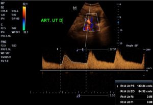 US_doppler_obsterico