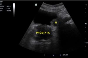 US_prostata