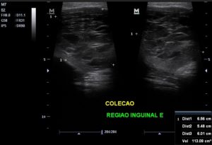 US_regiao_inguinal