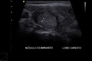 US_tireoide
