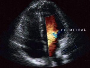 ecocardiografia_ecocardiograma